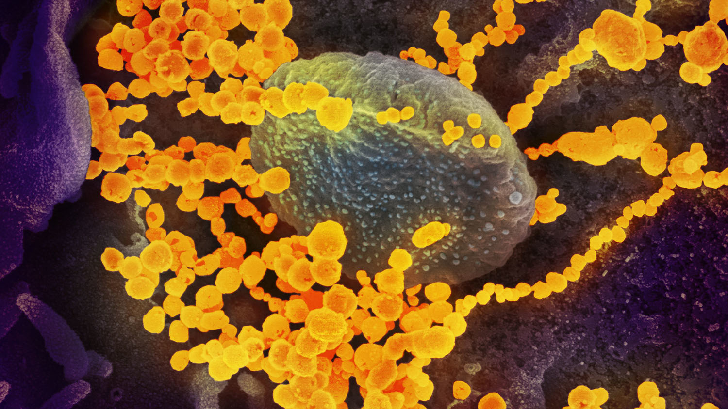 microscopy image of SARS-CoV-2 viruses